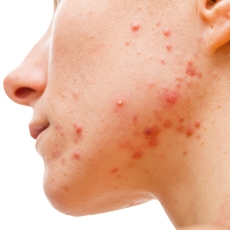 Acne & Pimples