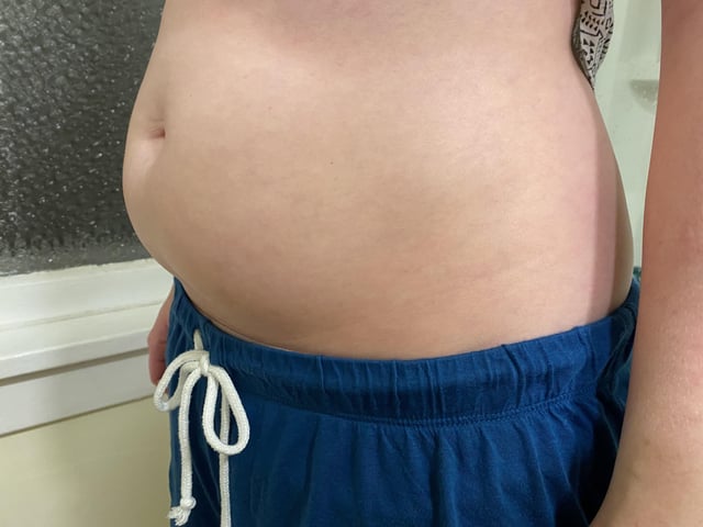 Bloating